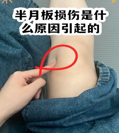 官方：高迪左膝内侧半月板后角撕裂，恢复时间为4周